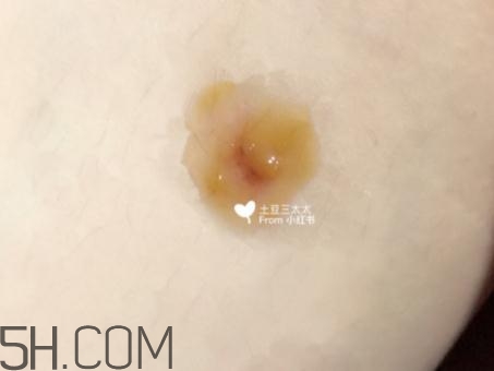 美寶濕潤燒傷膏怎么樣？美寶濕潤燒傷膏有用嗎？