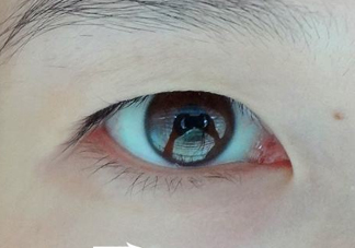 為什么會長脂肪粒？怎么消除眼睛上的脂肪粒？