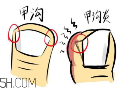 為什么容易得甲溝炎？怎么根治甲溝炎？