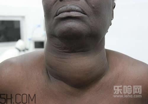 甲狀腺腫大和甲亢的區(qū)別有哪些？甲狀腺腫大適合吃什么食物？