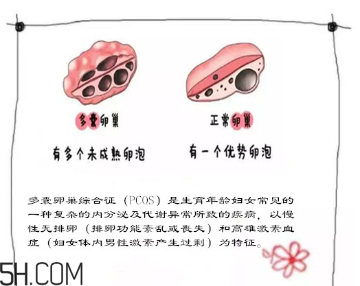 多囊卵巢生不了？多囊卵巢懷孕要看準(zhǔn)時間
