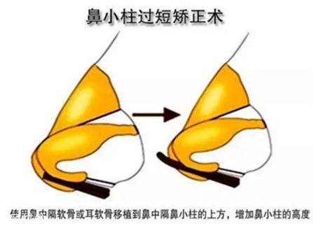 鼻小柱延長(zhǎng)用什么材料？?jī)?yōu)先選擇鼻中隔軟骨