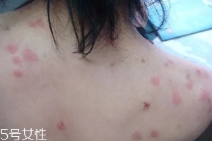 螨蟲有哪些危害？嚴(yán)重時(shí)肌膚糜爛