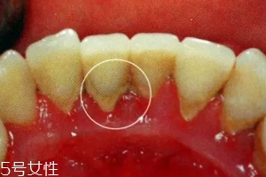 牙結(jié)石能自動(dòng)脫落嗎？除了洗牙別無他法