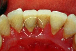 牙結(jié)石能自動脫落嗎？除了洗牙別無他法