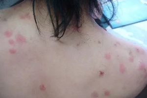 螨蟲有哪些危害？嚴(yán)重時(shí)肌膚糜爛