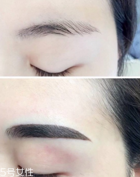激光洗眉恢復(fù)期有疤痕怎么辦？激光洗眉毛之后正確護(hù)理方法