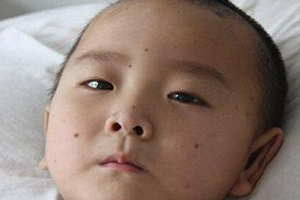 痣什么情況下會轉變?yōu)榱?？點痣不可取
