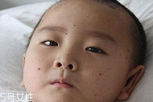 痣什么情況下會(huì)轉(zhuǎn)變?yōu)榱?？點(diǎn)痣不可取