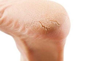 冬天裂腳怎么辦？5招緩解裂腳