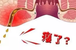 肛瘺非手術(shù)治療才可以嗎？手術(shù)是治療的關(guān)鍵途徑