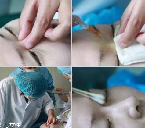 玻尿酸隆鼻維持時間受什么影響？玻尿酸不能過度注射