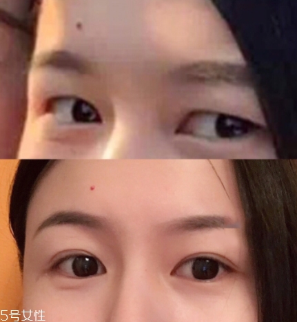 內(nèi)雙怎么進(jìn)化成雙眼皮？全是雙眼皮貼的功勞