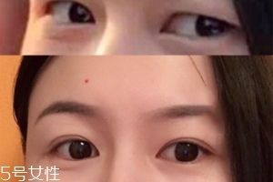內(nèi)雙怎么進(jìn)化成雙眼皮？全是雙眼皮貼的功勞