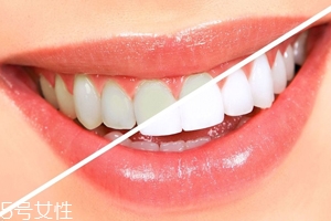 牙齒發(fā)黃是天生的嗎？只是你刷牙偷懶了