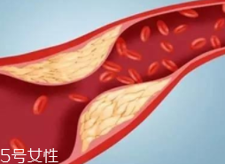 血管堵塞怎么自查？腿腳告訴你答案
