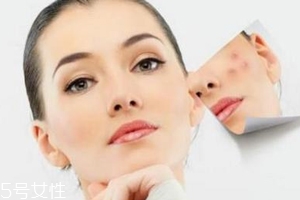 痘印多久能自行消失？多數(shù)人一年內(nèi)消失