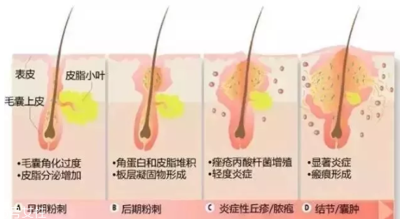 封閉性粉刺的發(fā)病機(jī)制是什么？角質(zhì)層太厚