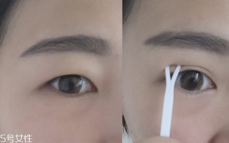 雙眼皮貼一般多少錢？