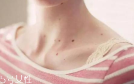色素痣是腫瘤嗎？良性腫瘤不必?fù)?dān)心