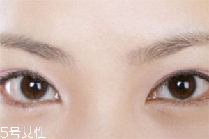 割雙眼皮后怎樣恢復快？女人不能割雙眼皮的時期