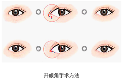 開眼角疤痕多久消失？開眼角的適宜人群