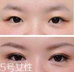 開眼角疤痕多久消失？開眼角的適宜人群