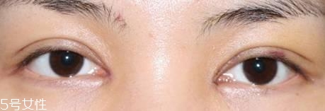 怎么縮短開眼角疤痕消失時間？雙眼皮開眼角恢復過程