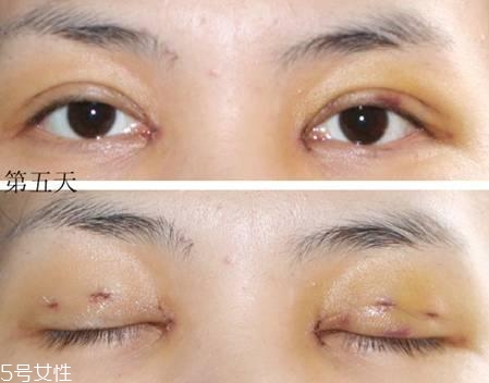 怎么縮短開眼角疤痕消失時間？雙眼皮開眼角恢復過程