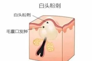 閉口是怎么引起的？4種情況要注意