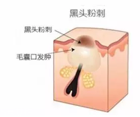 閉口是怎么引起的？4種情況要注意