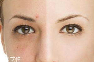 祛痘產品怎么選？先要分清痘印類型