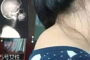 富貴包是什么病？姿態(tài)優(yōu)美少犯病