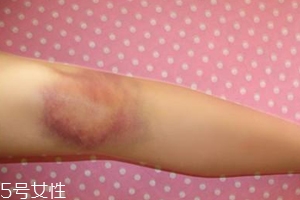 身體淤青怎么來的？不是磕碰那么簡單