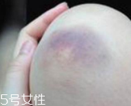 身體淤青怎么來的？不是磕碰那么簡單