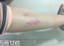 身體淤青怎么來的？不是磕碰那么簡單