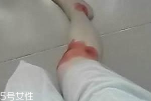 摔傷了涂什么藥好的快？做好消毒才能愈合快