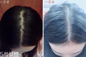 柳屋生發(fā)水有用嗎？一個(gè)月后長(zhǎng)出新發(fā)