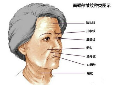 川字紋可以打玻尿酸嗎？不是最佳選擇