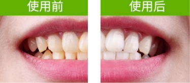 牙貼怎么分上下牙貼？牙貼怎么分正反