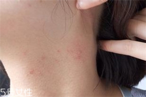 脖子長痘痘怎么辦 教你脖子護(hù)理方法