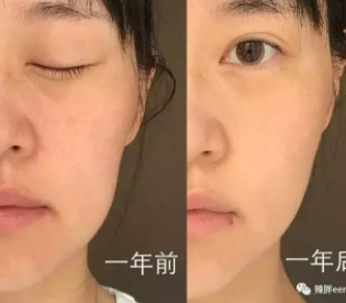 童顏機有用嗎？童顏機的功效