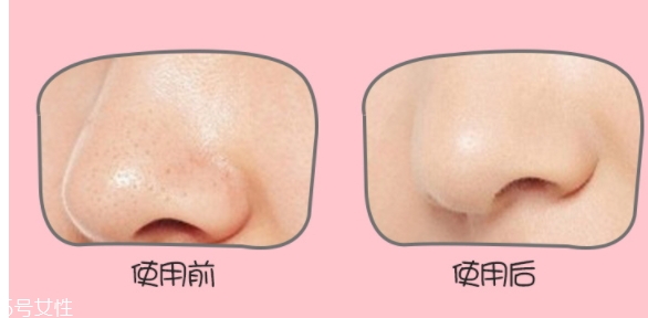 yoii黑頭儀怎么用？yoii黑頭儀怎么充電
