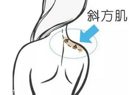 瘦肩針間隔多久打一次？打瘦肩針間隔時(shí)間