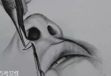 鼻翼外切多久消腫？鼻翼外切消腫時(shí)間要多長(zhǎng)？