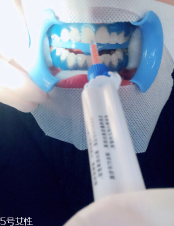 冷光美白會反彈嗎？冷光美白心得