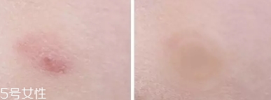 vt痘痘貼怎么用？vt老虎痘痘貼防水嗎
