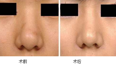 縮鼻手術多久恢復？縮鼻手術傷口才會好