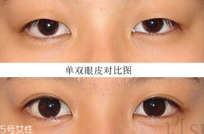 內雙怎么變成雙的 內雙怎么變外雙小妙招