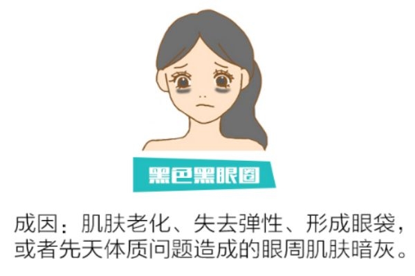 如何分辨黑眼圈類型 找對類型對癥下藥